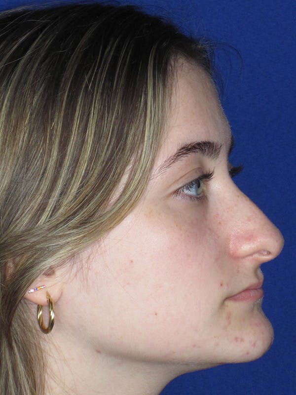 Rhinoplasty Before & After Gallery - Patient 165416662 - Image 1