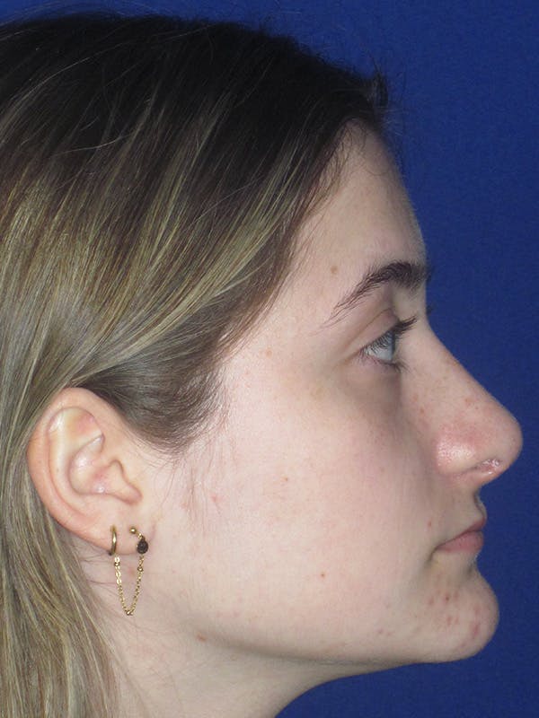 Rhinoplasty Before & After Gallery - Patient 165416662 - Image 2