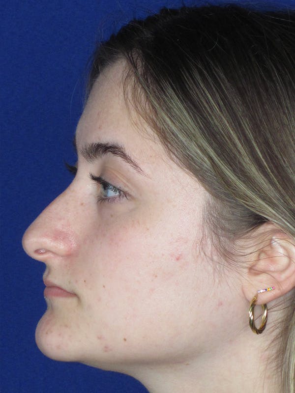 Rhinoplasty Before & After Gallery - Patient 165416662 - Image 5