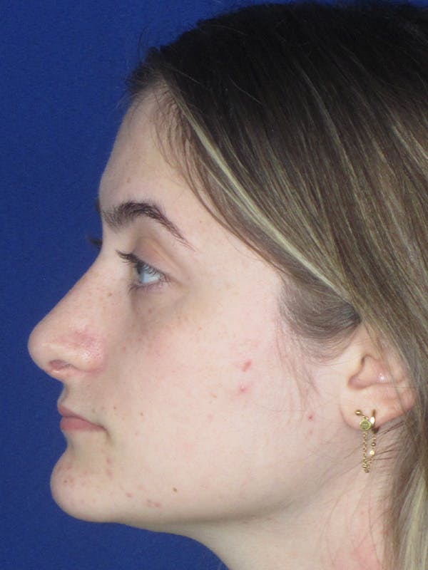 Rhinoplasty Before & After Gallery - Patient 165416662 - Image 6