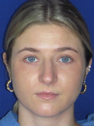 Rhinoplasty Before & After Gallery - Patient 165416663 - Image 1