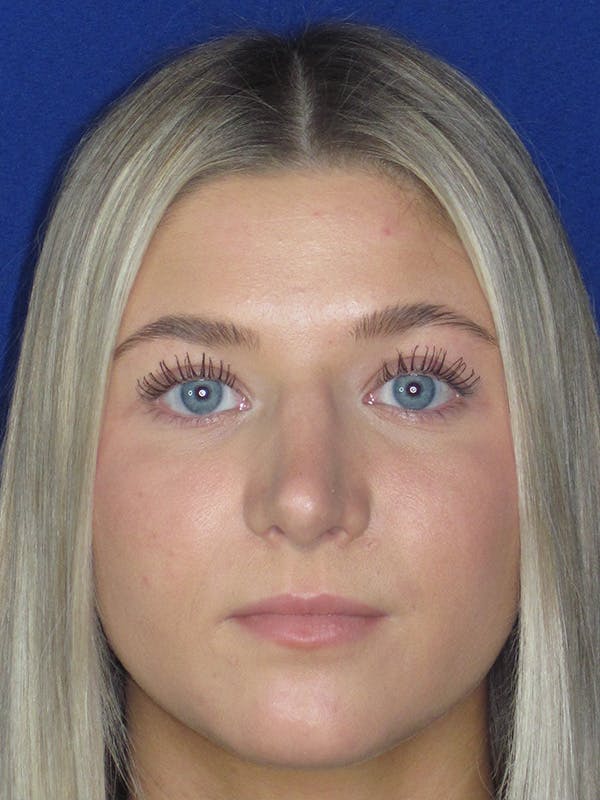 Rhinoplasty Before & After Gallery - Patient 165416663 - Image 2
