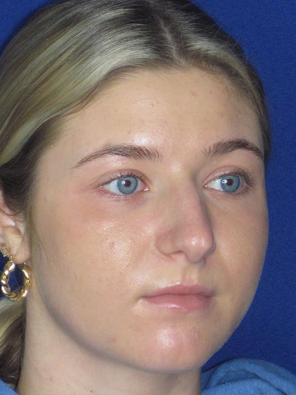Rhinoplasty Before & After Gallery - Patient 165416663 - Image 3