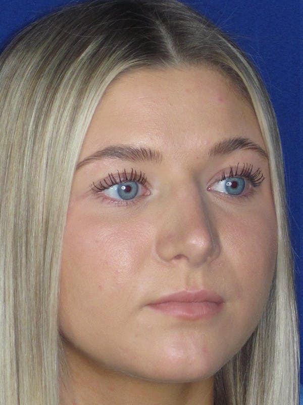 Rhinoplasty Before & After Gallery - Patient 165416663 - Image 4