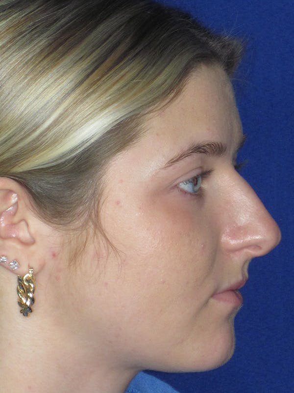 Rhinoplasty Before & After Gallery - Patient 165416663 - Image 5