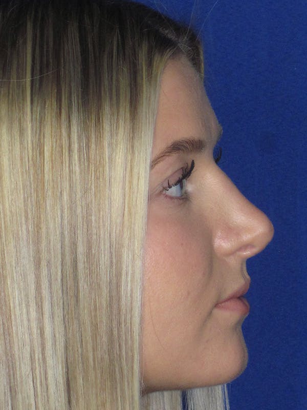 Rhinoplasty Before & After Gallery - Patient 165416663 - Image 6