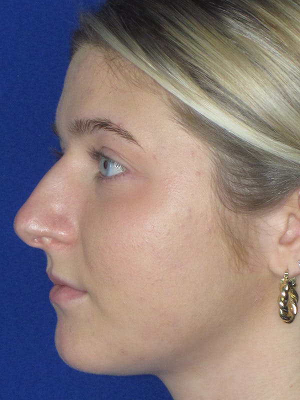 Rhinoplasty Before & After Gallery - Patient 165416663 - Image 7
