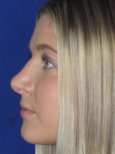 Rhinoplasty Before & After Gallery - Patient 165416663 - Image 8