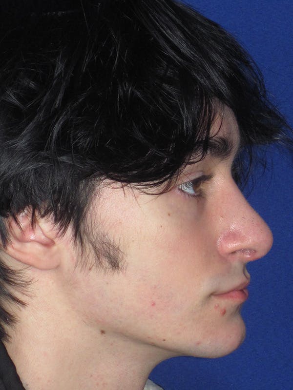 Rhinoplasty Before & After Gallery - Patient 165416664 - Image 4