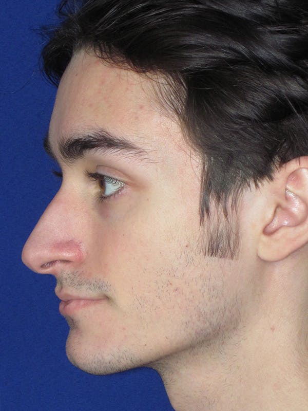 Rhinoplasty Before & After Gallery - Patient 165416664 - Image 7