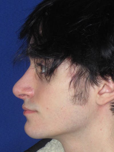 Rhinoplasty Before & After Gallery - Patient 165416664 - Image 8