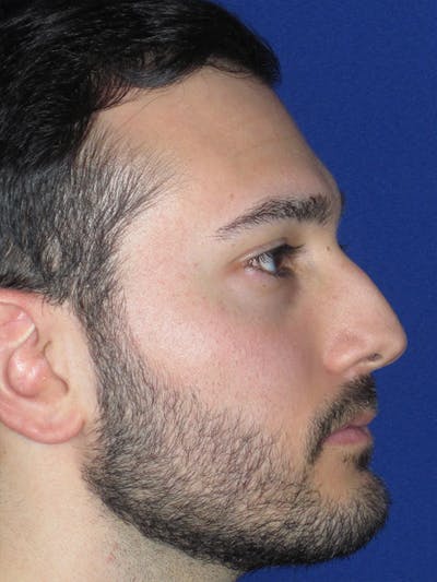 Rhinoplasty Before & After Gallery - Patient 153153199 - Image 1