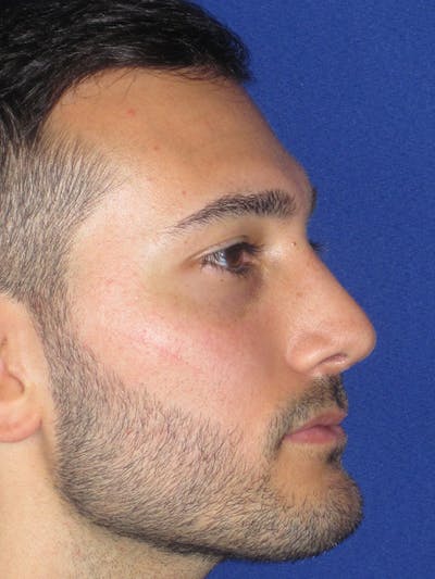 Rhinoplasty Before & After Gallery - Patient 153153199 - Image 2