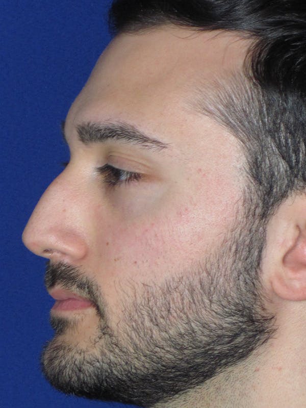 Rhinoplasty Before & After Gallery - Patient 153153199 - Image 7