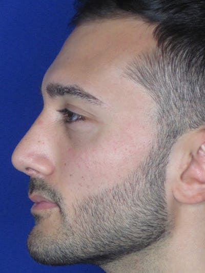 Rhinoplasty Before & After Gallery - Patient 153153199 - Image 8