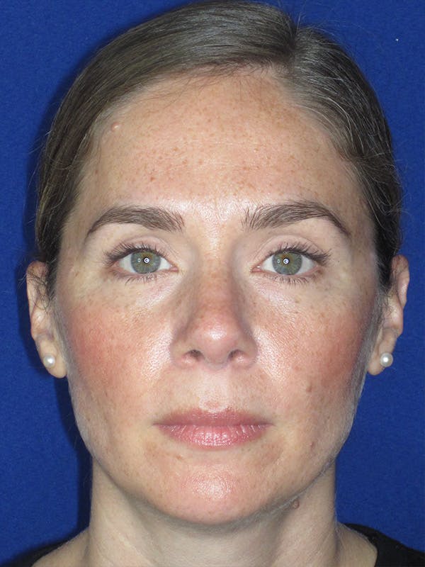 Rhinoplasty Before & After Gallery - Patient 165416665 - Image 1