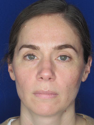 Rhinoplasty Before & After Gallery - Patient 165416665 - Image 2