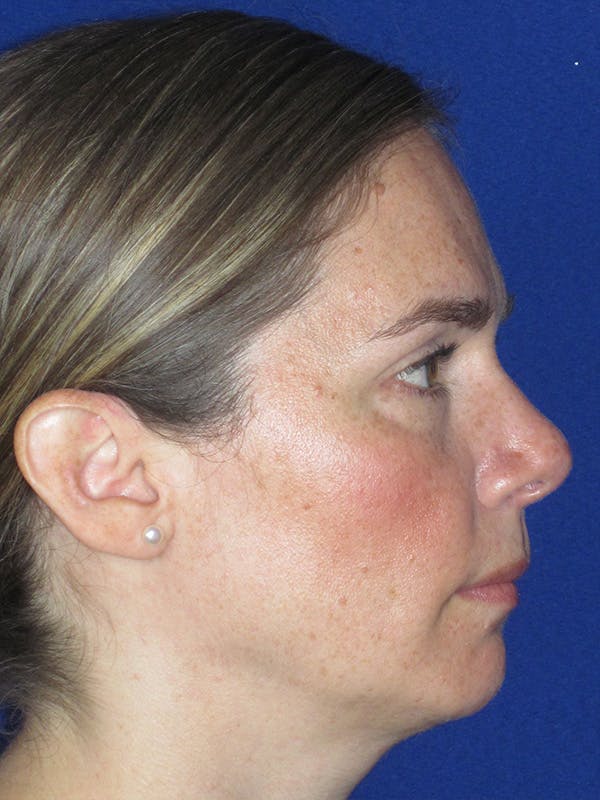 Rhinoplasty Before & After Gallery - Patient 165416665 - Image 5