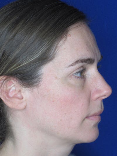 Rhinoplasty Before & After Gallery - Patient 165416665 - Image 6