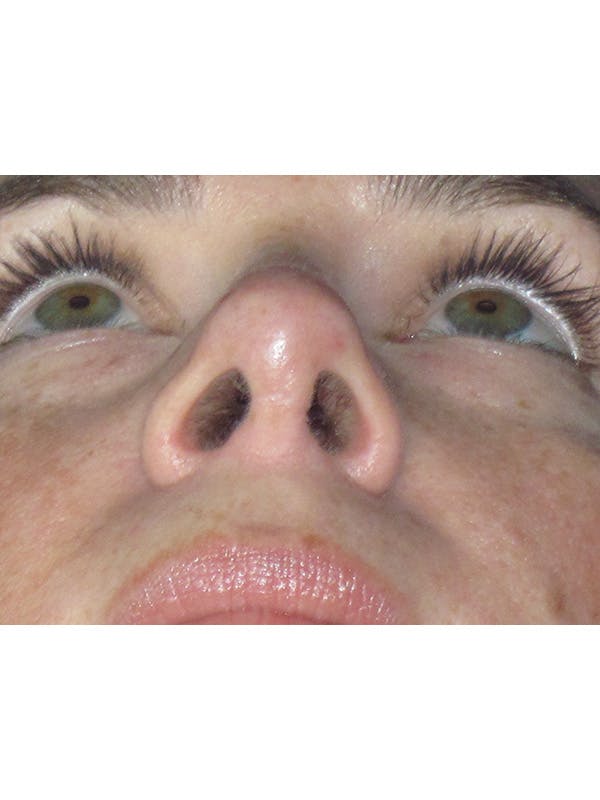 Rhinoplasty Before & After Gallery - Patient 165416665 - Image 8