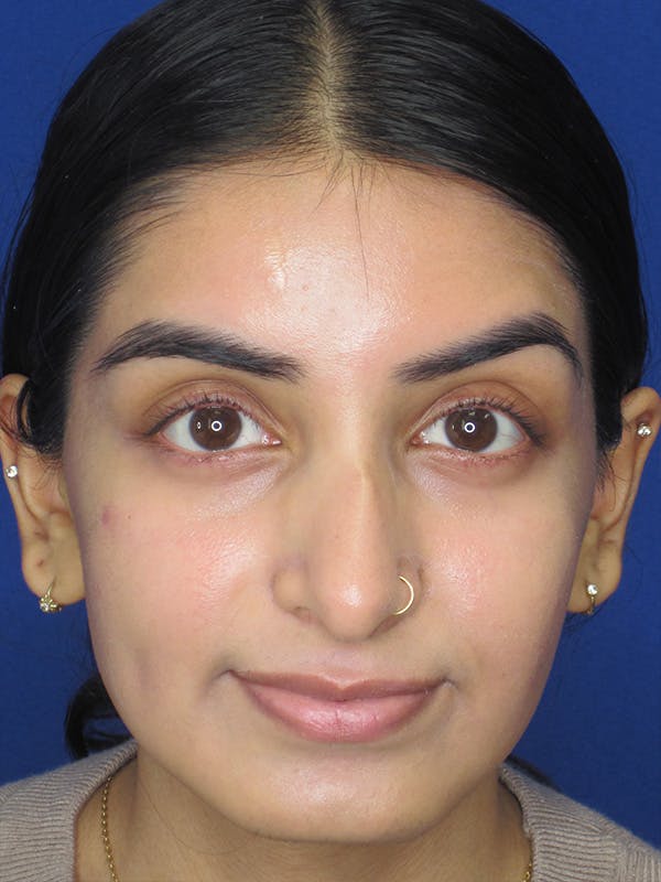 Rhinoplasty Before & After Gallery - Patient 165416666 - Image 3