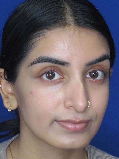 Rhinoplasty Before & After Gallery - Patient 165416666 - Image 1
