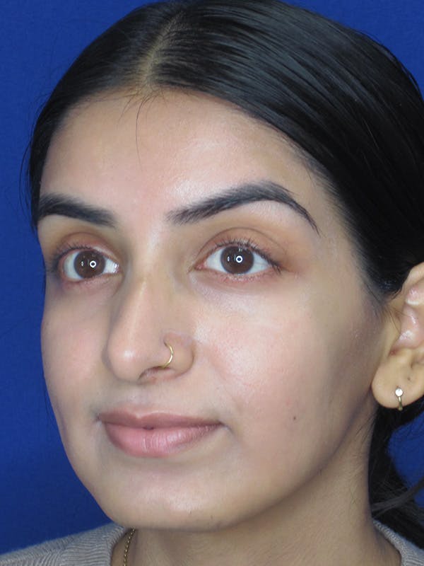 Rhinoplasty Before & After Gallery - Patient 165416666 - Image 7