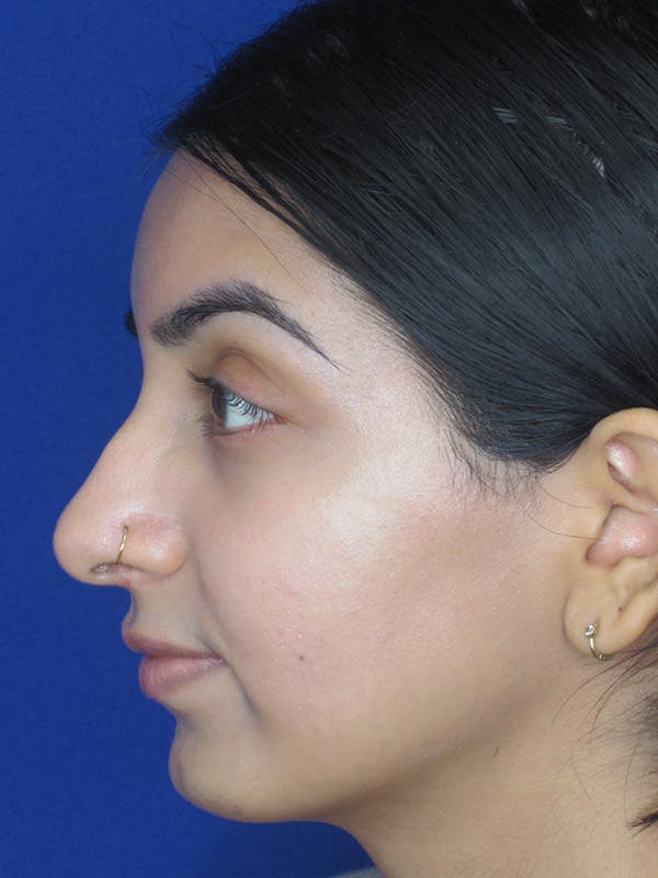 Rhinoplasty Before & After Gallery - Patient 165416666 - Image 5