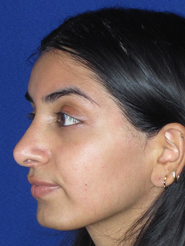 Rhinoplasty Before & After Gallery - Patient 165416666 - Image 6