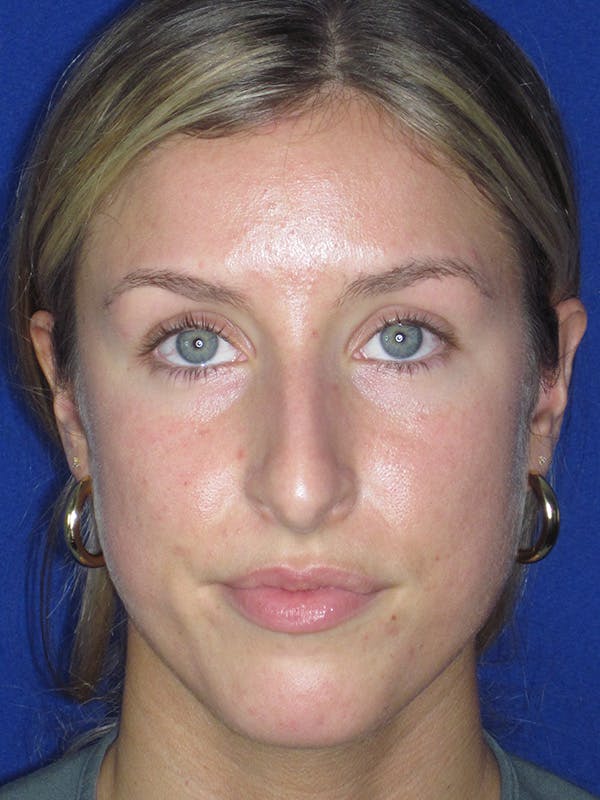 Rhinoplasty Before & After Gallery - Patient 165416667 - Image 9