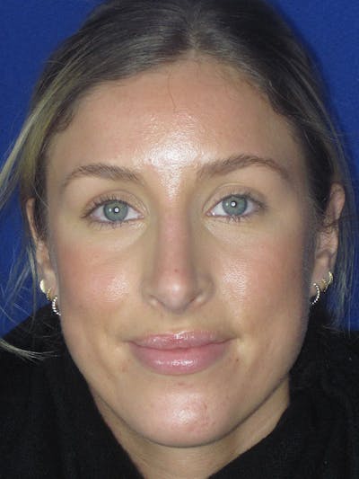 Rhinoplasty Before & After Gallery - Patient 165416667 - Image 10