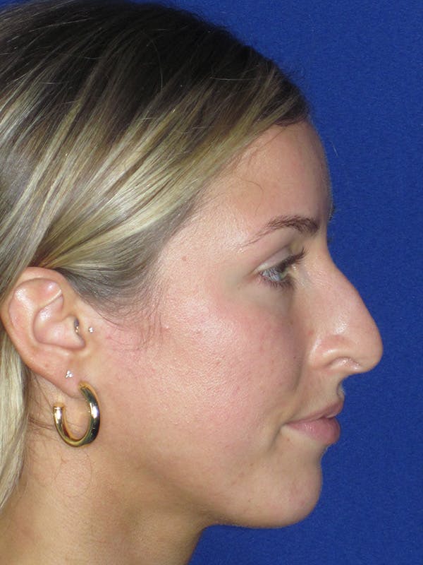 Rhinoplasty Before & After Gallery - Patient 165416667 - Image 1