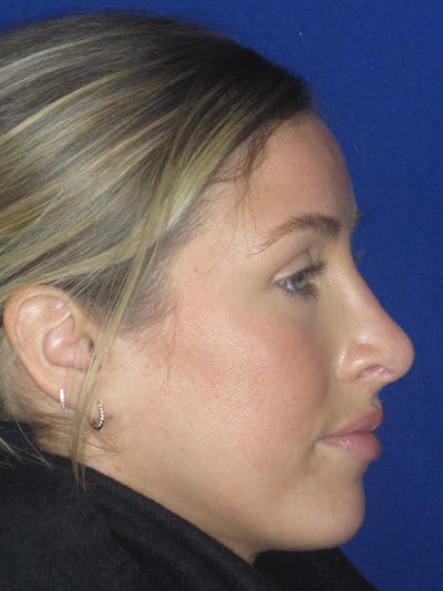 Rhinoplasty Before & After Gallery - Patient 165416667 - Image 2