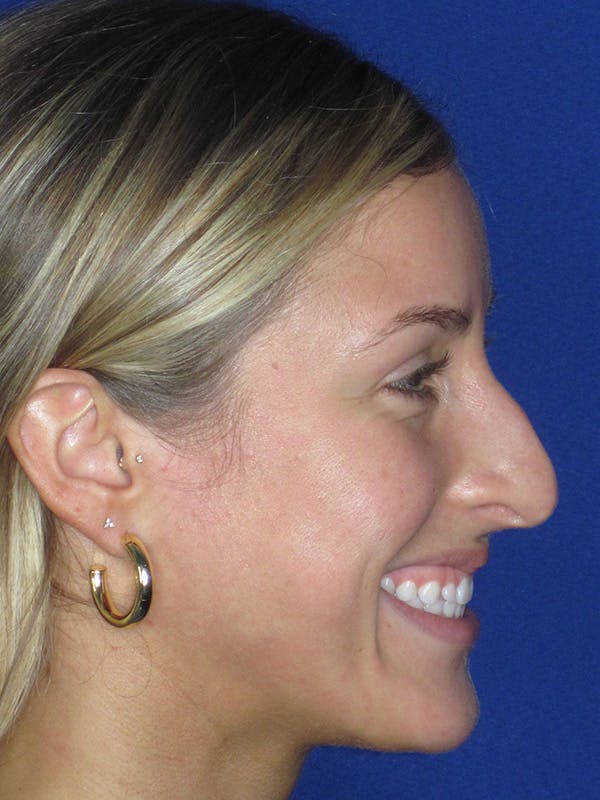 Rhinoplasty Before & After Gallery - Patient 165416667 - Image 7