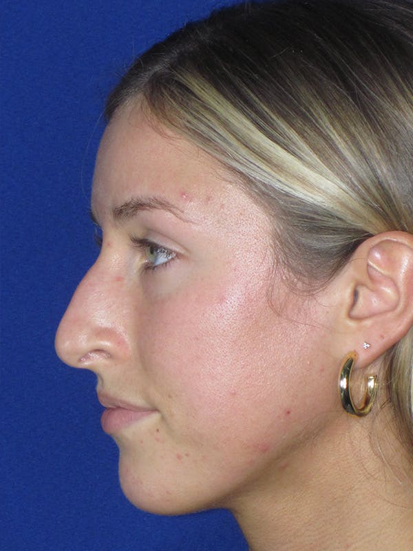 Rhinoplasty Before & After Gallery - Patient 165416667 - Image 5