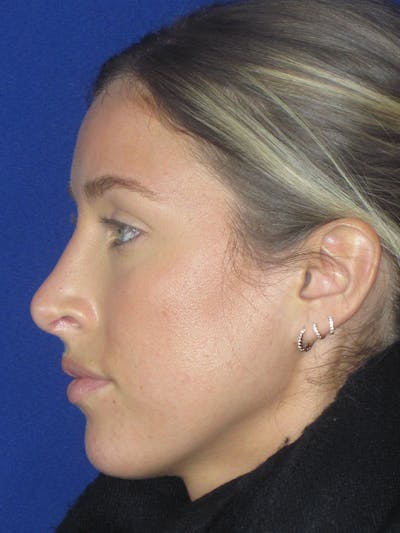 Rhinoplasty Before & After Gallery - Patient 165416667 - Image 6
