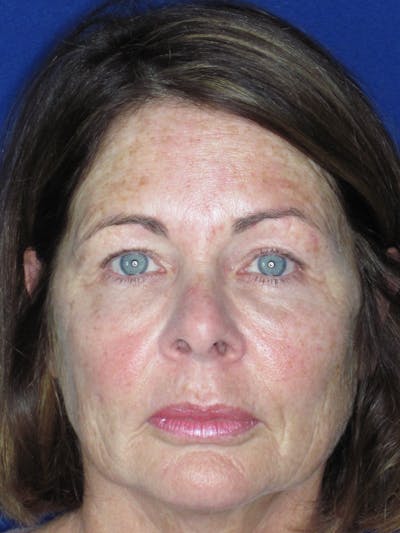Blepharoplasty Before & After Gallery - Patient 165418104 - Image 4