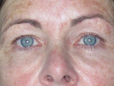 Blepharoplasty Before & After Gallery - Patient 165418104 - Image 1