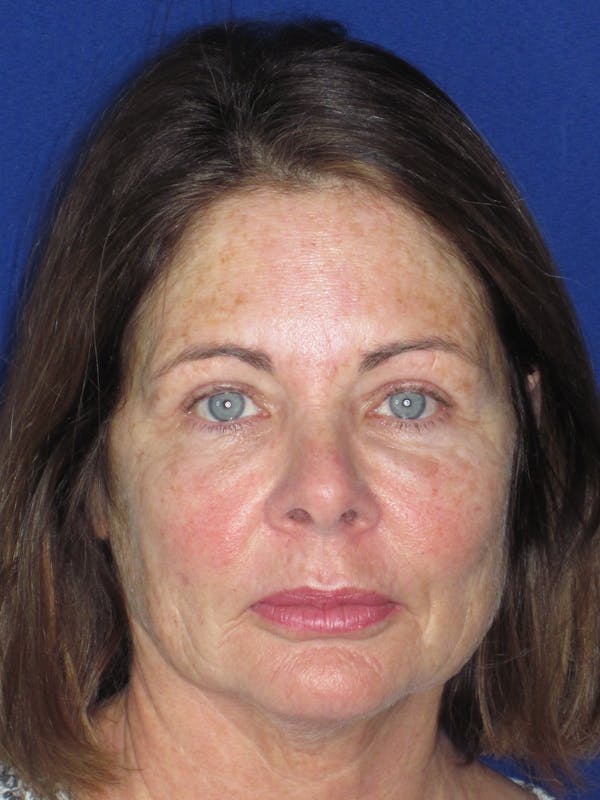 Blepharoplasty Before & After Gallery - Patient 165418104 - Image 3