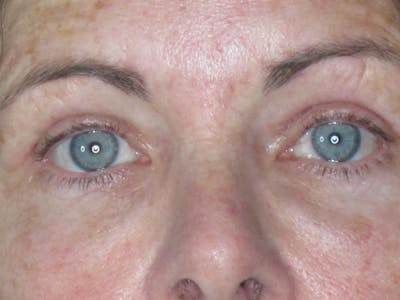 Blepharoplasty Before & After Gallery - Patient 165418104 - Image 2