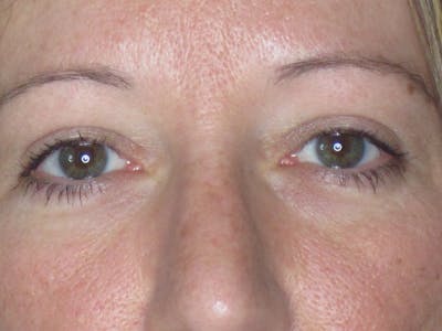 Blepharoplasty Before & After Gallery - Patient 165418105 - Image 2