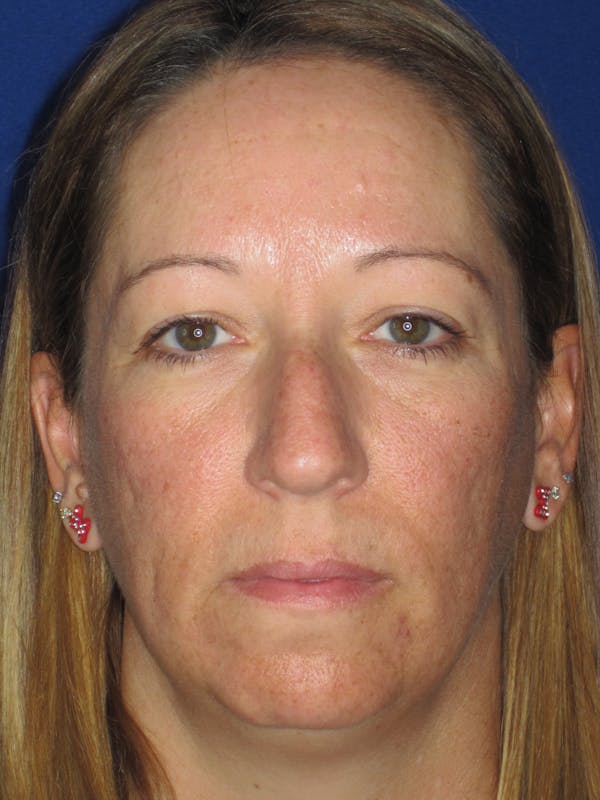 Blepharoplasty Before & After Gallery - Patient 165418105 - Image 3
