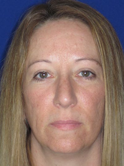 Blepharoplasty Before & After Gallery - Patient 165418105 - Image 4