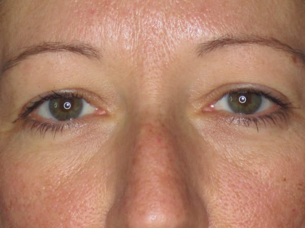 Blepharoplasty Before & After Gallery - Patient 165418105 - Image 1
