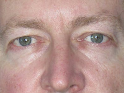 Blepharoplasty Before & After Gallery - Patient 165418106 - Image 1