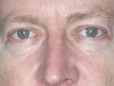 Blepharoplasty Before & After Gallery - Patient 165418106 - Image 2