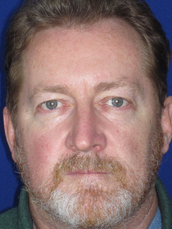 Blepharoplasty Before & After Gallery - Patient 165418106 - Image 3