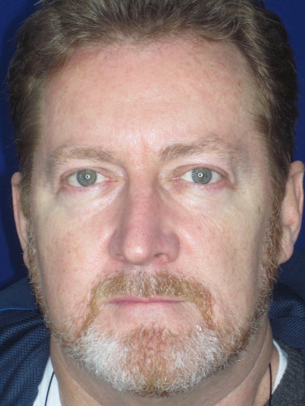 Blepharoplasty Before & After Gallery - Patient 165418106 - Image 4