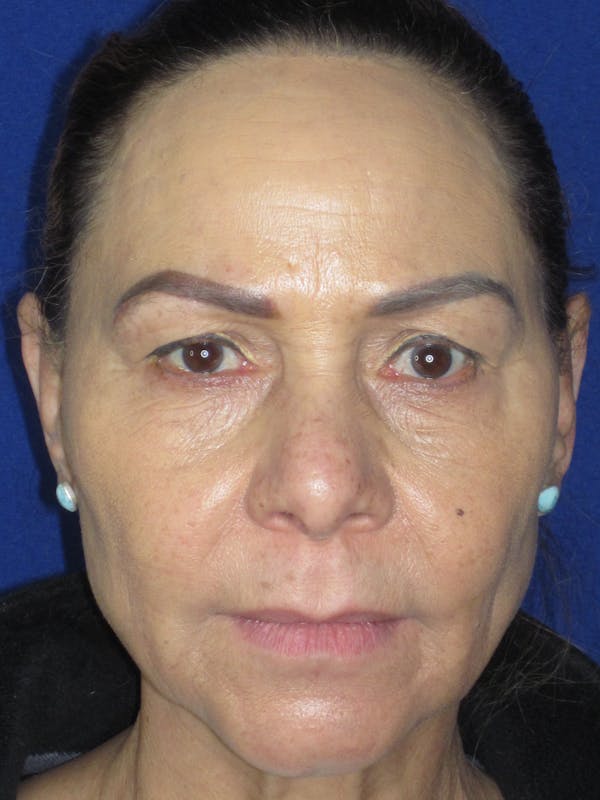 Blepharoplasty Before & After Gallery - Patient 165418111 - Image 3