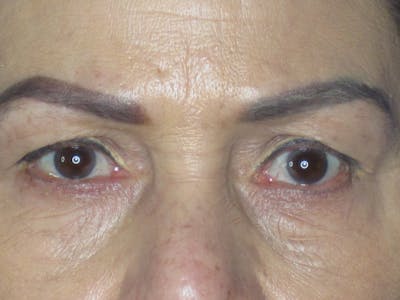 Blepharoplasty Before & After Gallery - Patient 165418111 - Image 1